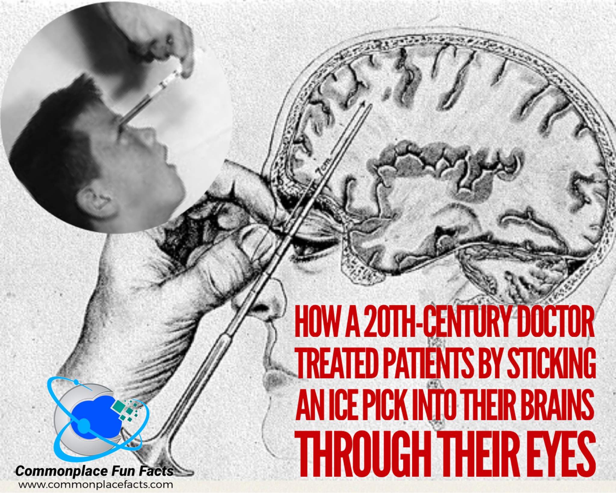 Ice Pick Lobotomy Through the Eye: The Horrifying Practice of a 20th-Century Medical Professional