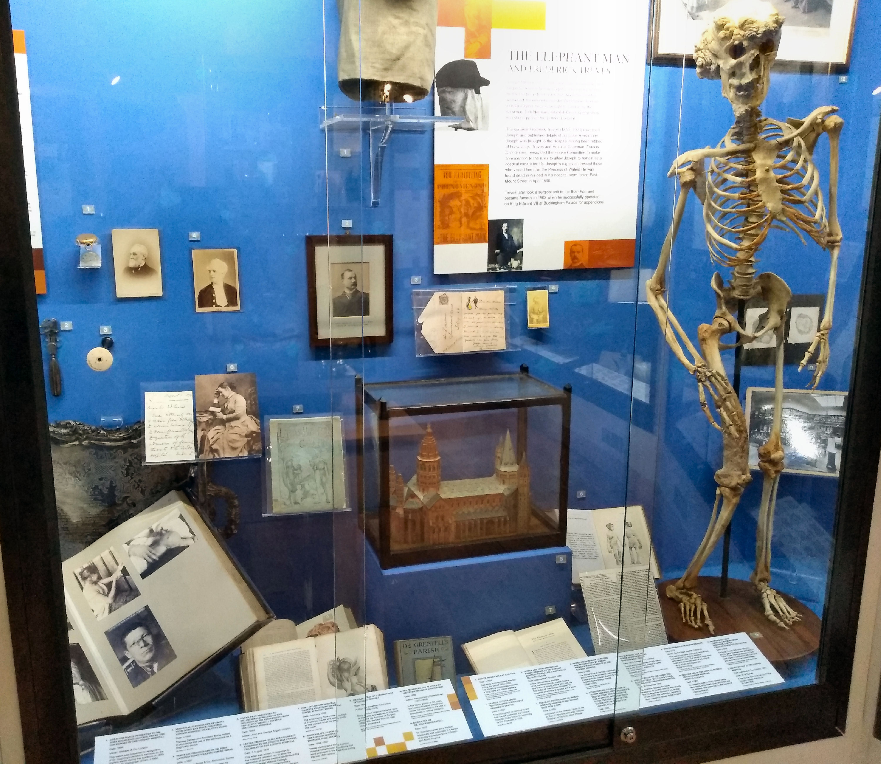 Joseph Merrick's skeleton on display at the Royal London Hospital